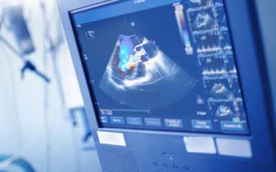 What is a Cardiac Ultrasound?